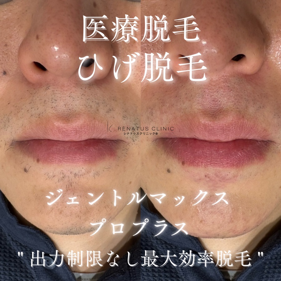 医療 ひげ脱毛（鼻下・顎）のビフォーアフター症例 富山・高岡